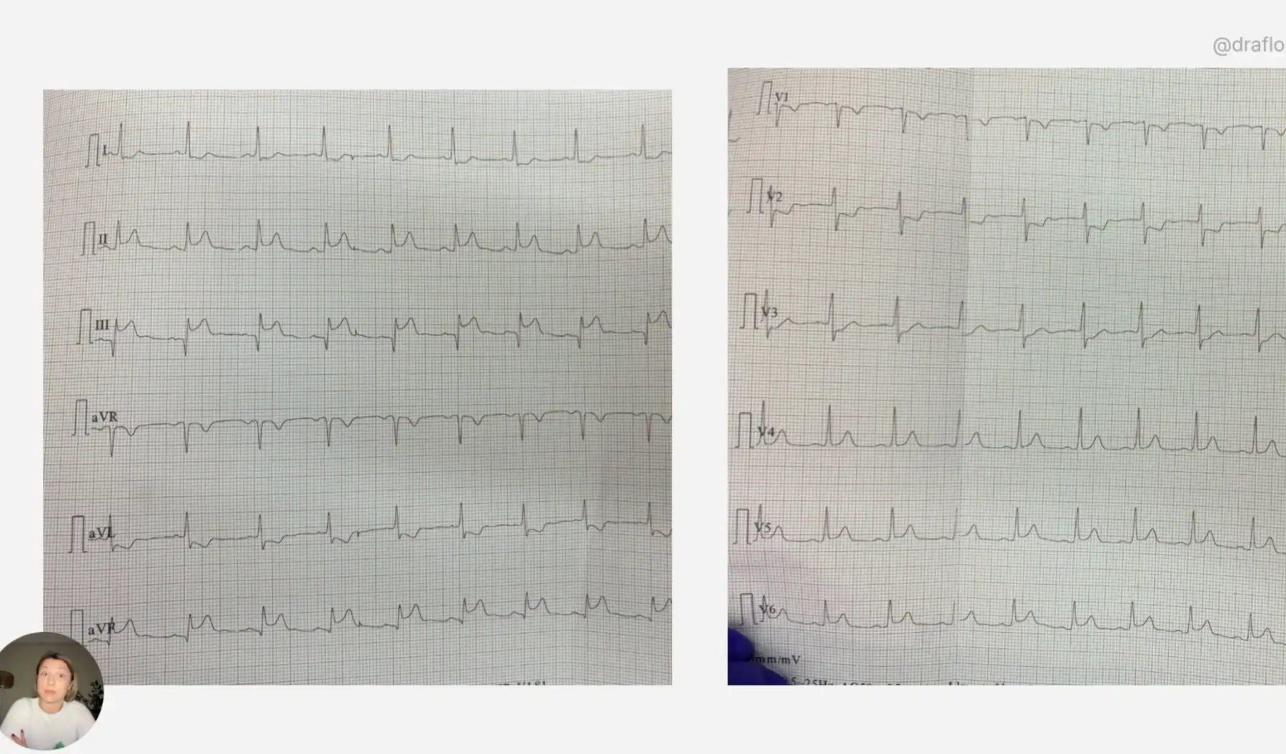 ECG de 12 derivaciones del caso clínico de dolor torácico